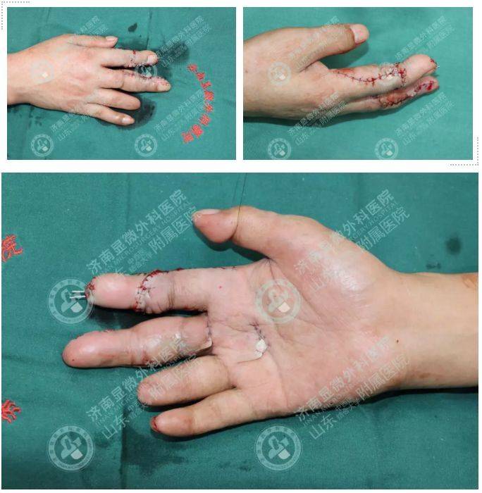 手指再造术(手指再造术有后遗症吗)